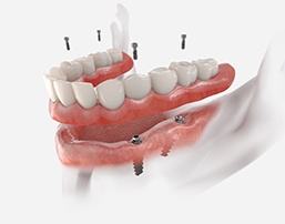 a digital illustration showing how implant dentures work