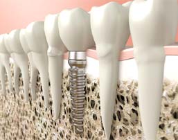 Dental implant in Royse City
