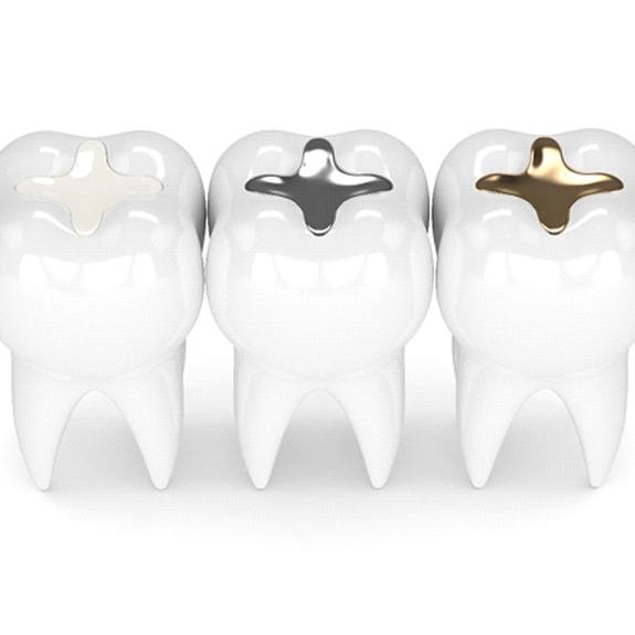 Three types of dental fillings side by side