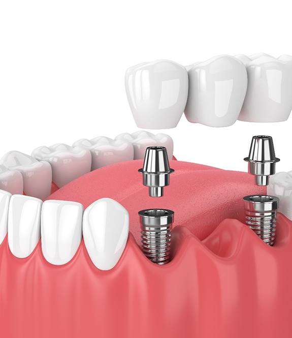 3D render of a dental bridge