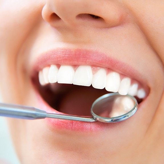 Closeup of smile after tooth-colored filling placement