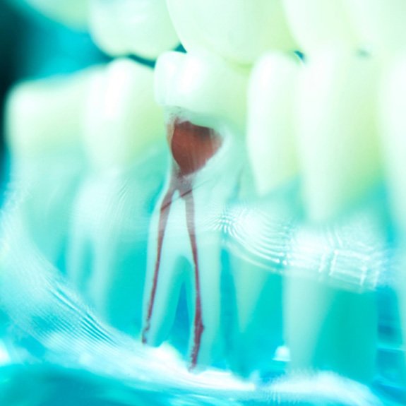 a model of teeth with one infected one