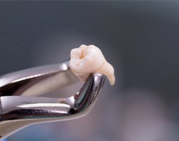 dental forceps holding an extracted tooth 