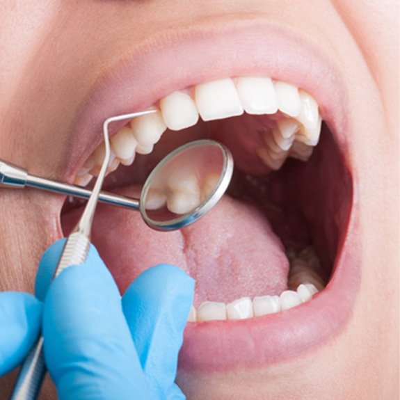 Closeup of patient getting a dental checkup in Royse City