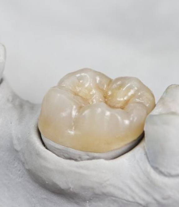 A dental crown sitting in a mold.