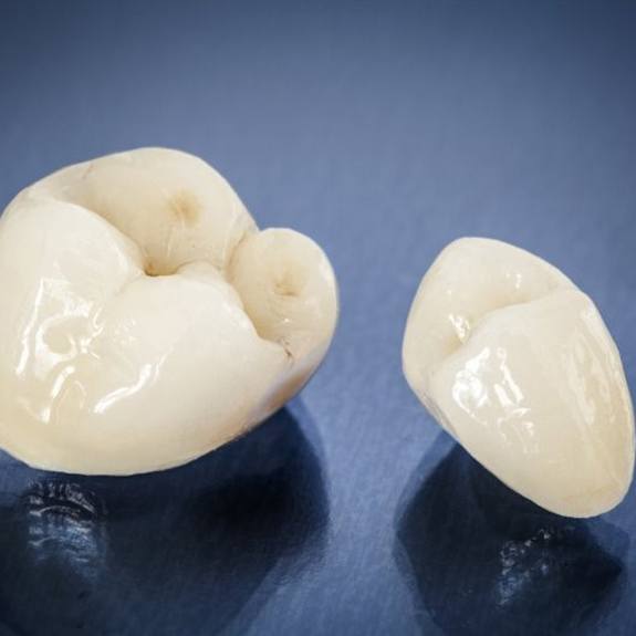A pair of dental crowns in Royse City, TX.