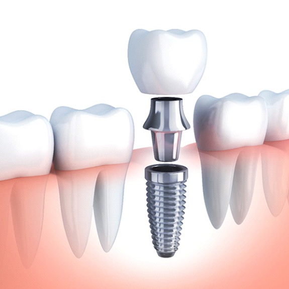 Diagram showing parts of a dental implant in Royse City