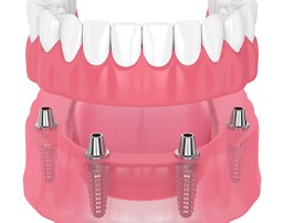 illustration of implant dentures for cost of dentures in Royse City 