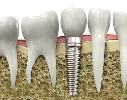Parts of a single dental implant