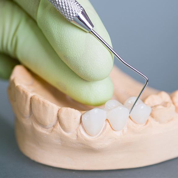 Model smile with fixed bridge restoration