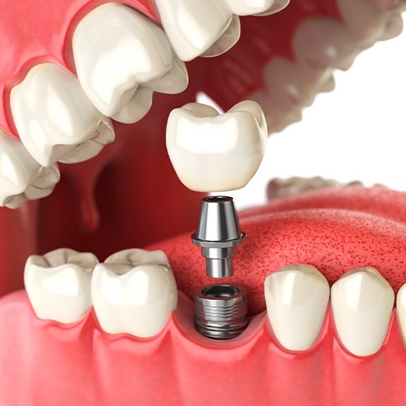 Animated implant supported dental crown