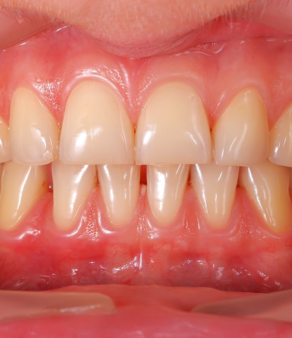 A mouth with mild gum disease.