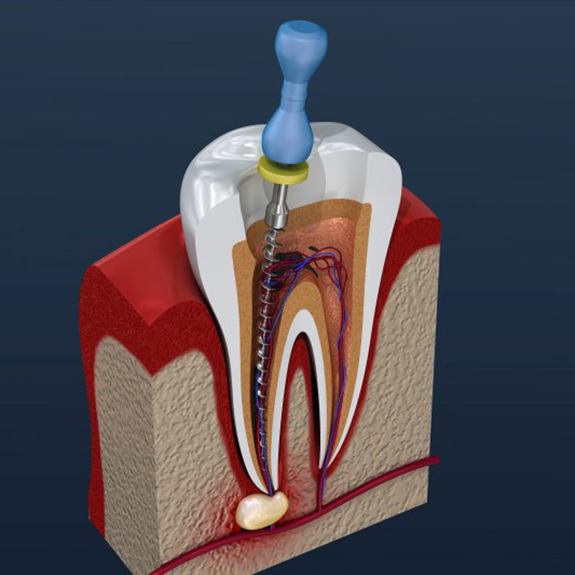 An illustration of a root canal in Royse City, TX