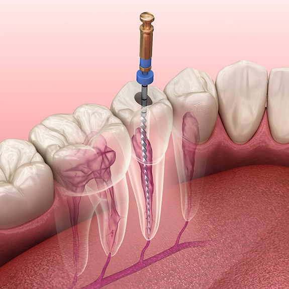 3D Diagram of a Root Canal