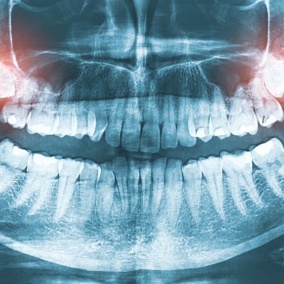 X-ray with wisdom teeth highlighted in red