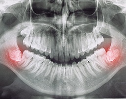 X-ray of wisdom teeth