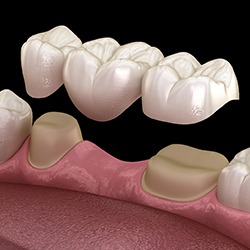 Digital model of a bridge and crowns