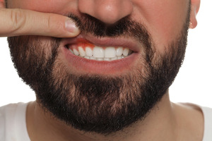 Bearded man pulling up lip to show inflamed gums